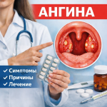Ангина: причины, симптомы, диагностика и лечение